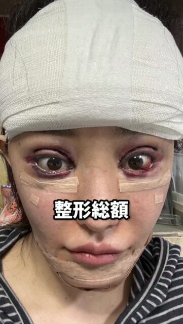 AYAKOREA、整形総額2360万円になりました
#美容整形 #渡韓整形 #あやオンニ
ーーーーーーーーーーーーーーー
整形のことなら"あやオンニ"🇰🇷
💵総額2,020万円超のリアルガチ勢
✈️渡韓整形フルサポート
(通訳/ケア/同行)
🇰🇷政府公認
無料相談受付中✨
詳細はプロフィールの公式LINEをチェック！